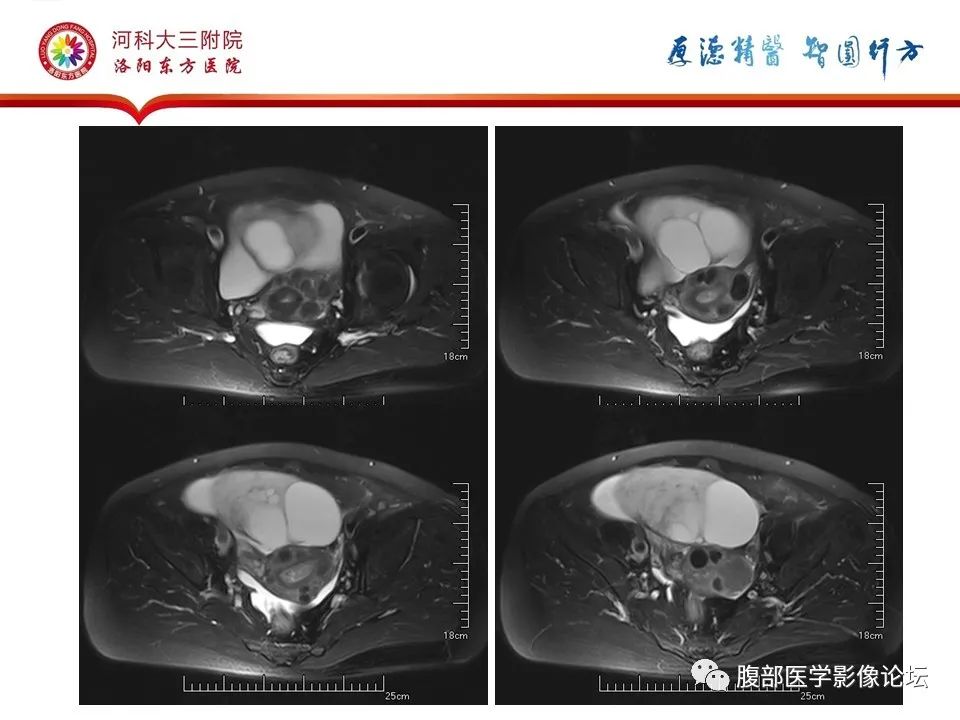 影像PPT - 【病例】卵泡膜细胞瘤1例MR影像-3