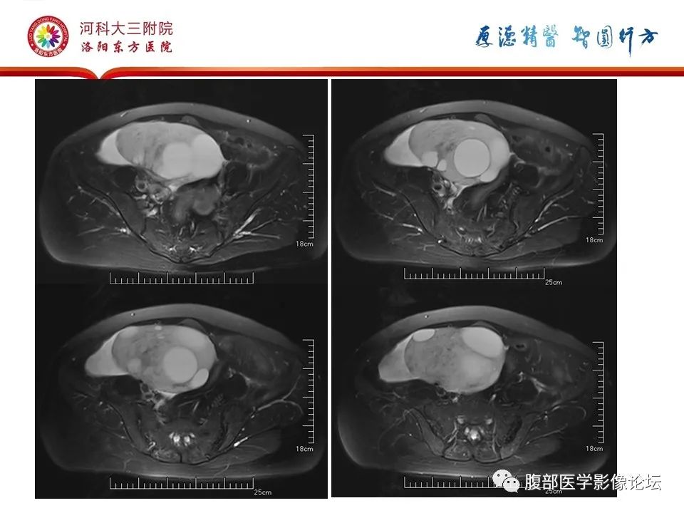 影像PPT - 【病例】卵泡膜细胞瘤1例MR影像-4