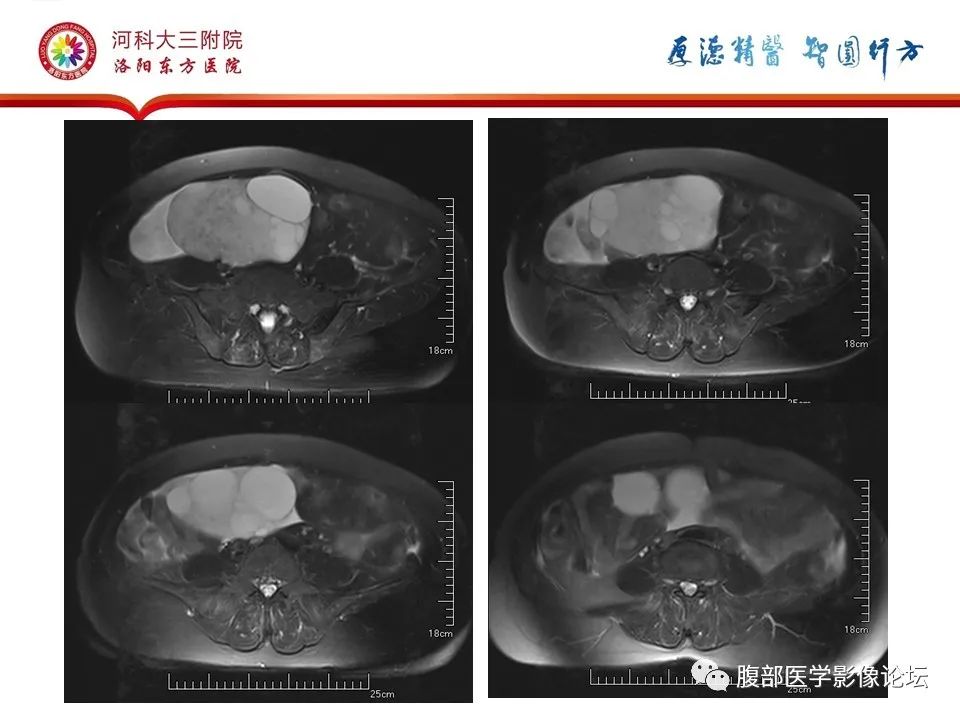 影像PPT - 【病例】卵泡膜细胞瘤1例MR影像-5