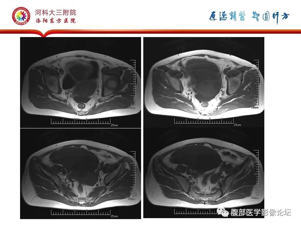 影像PPT - 【病例】卵泡膜细胞瘤1例MR影像-6