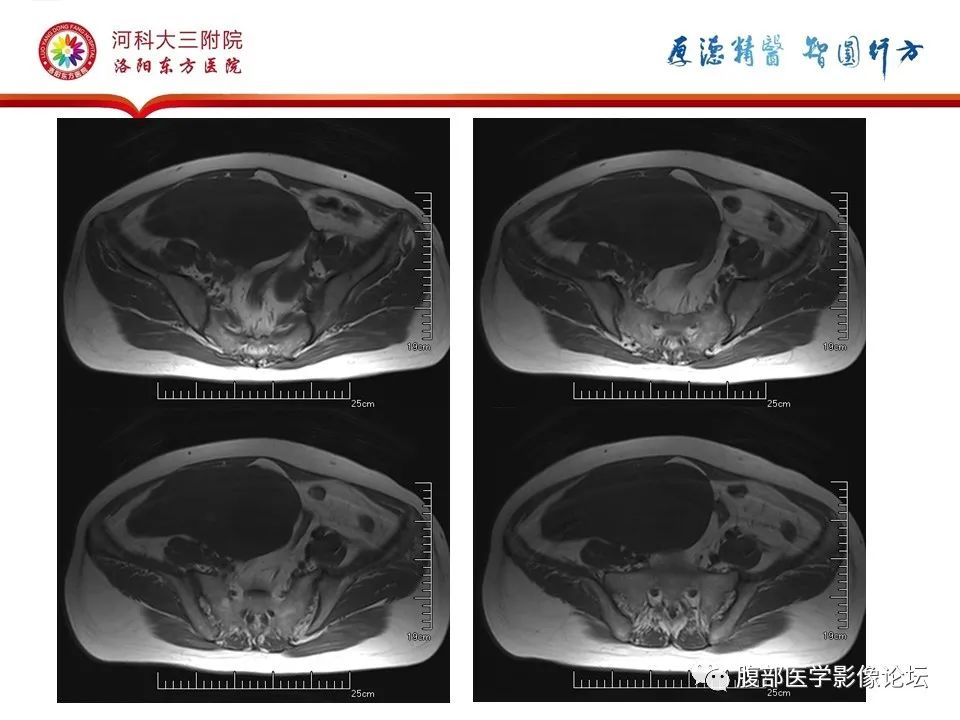 影像PPT - 【病例】卵泡膜细胞瘤1例MR影像-7