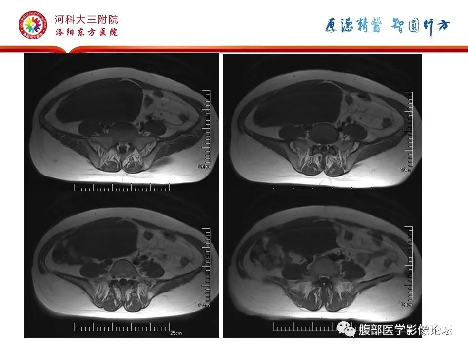 影像PPT - 【病例】卵泡膜细胞瘤1例MR影像-8