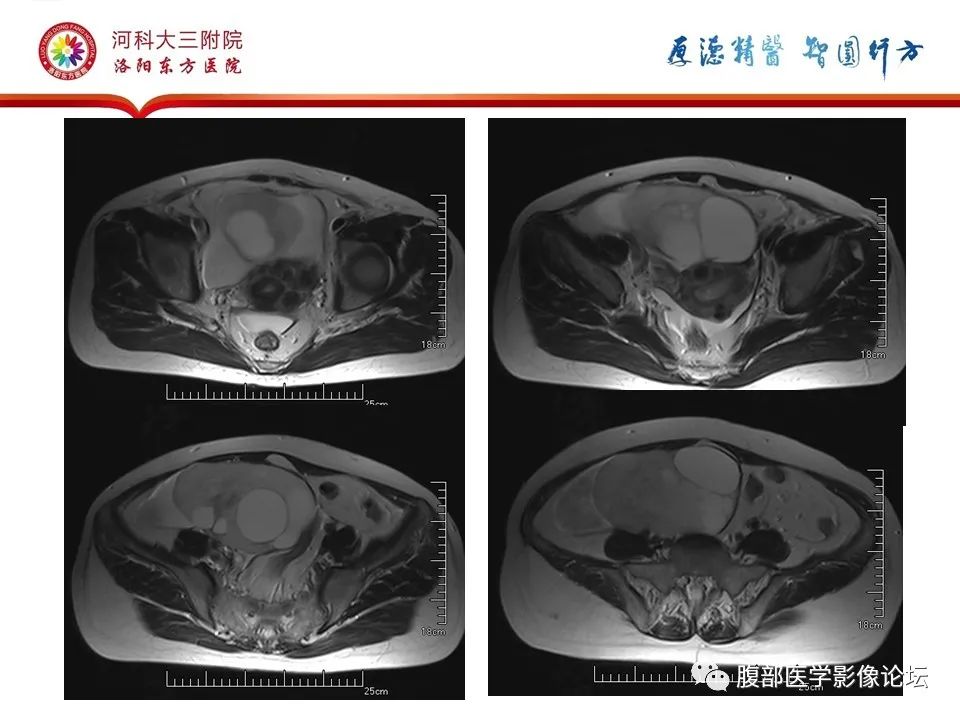 影像PPT - 【病例】卵泡膜细胞瘤1例MR影像-9