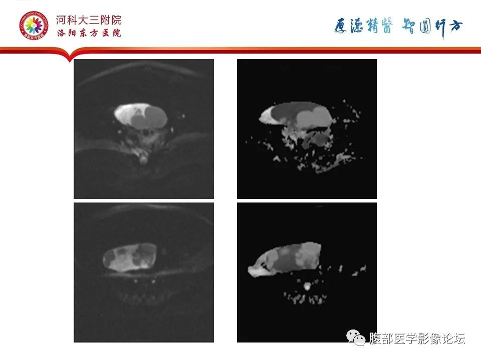 影像PPT - 【病例】卵泡膜细胞瘤1例MR影像-10