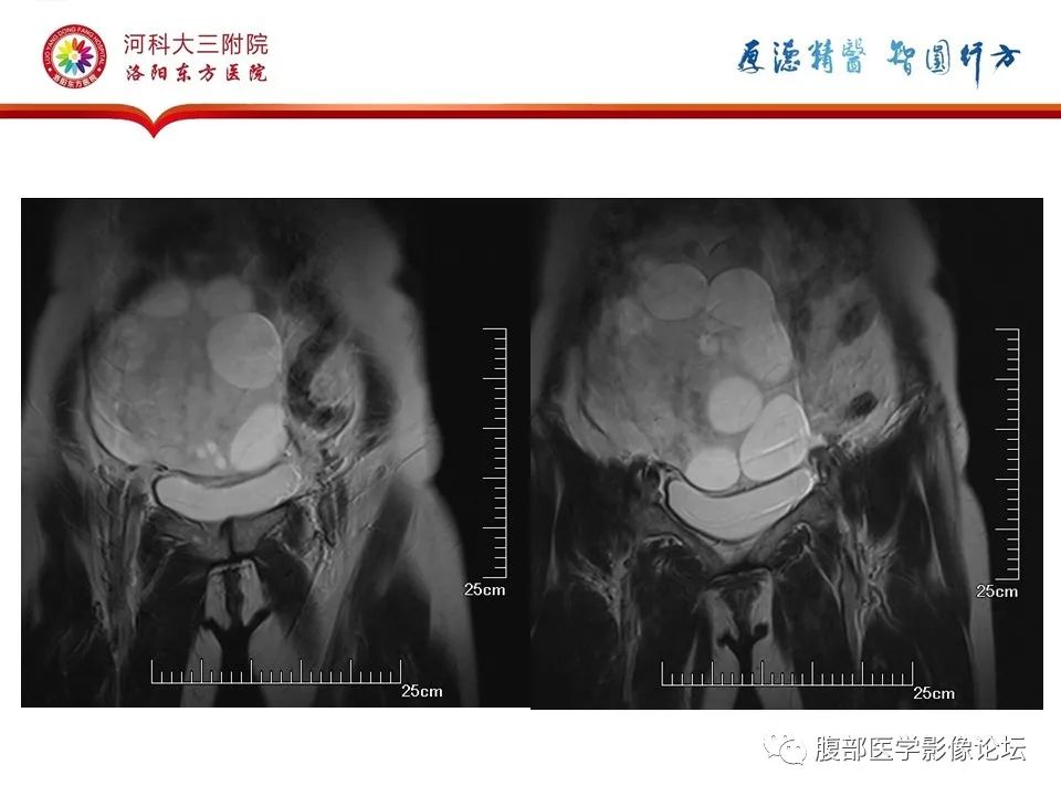 影像PPT - 【病例】卵泡膜细胞瘤1例MR影像-11