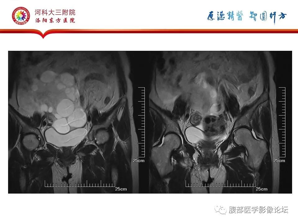 影像PPT - 【病例】卵泡膜细胞瘤1例MR影像-12