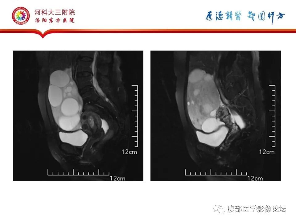 影像PPT - 【病例】卵泡膜细胞瘤1例MR影像-13