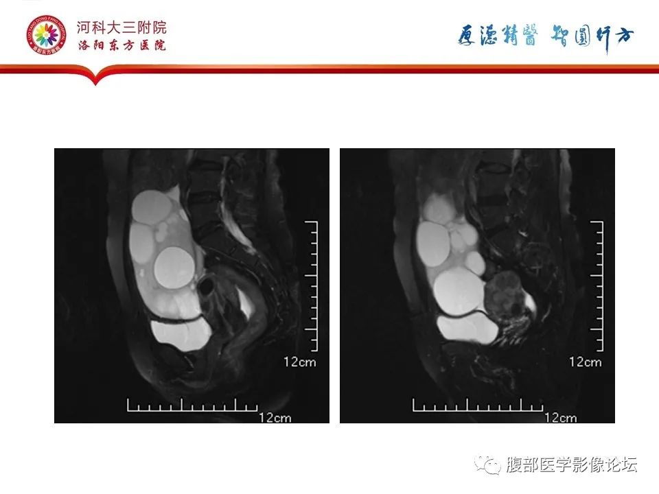 影像PPT - 【病例】卵泡膜细胞瘤1例MR影像-14