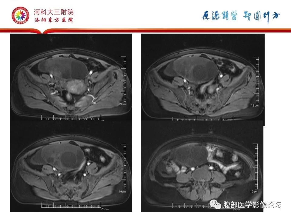 影像PPT - 【病例】卵泡膜细胞瘤1例MR影像-15