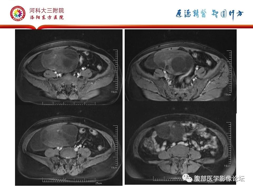 影像PPT - 【病例】卵泡膜细胞瘤1例MR影像-16
