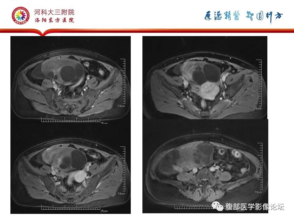 影像PPT - 【病例】卵泡膜细胞瘤1例MR影像-17