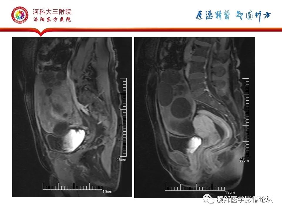 影像PPT - 【病例】卵泡膜细胞瘤1例MR影像-18