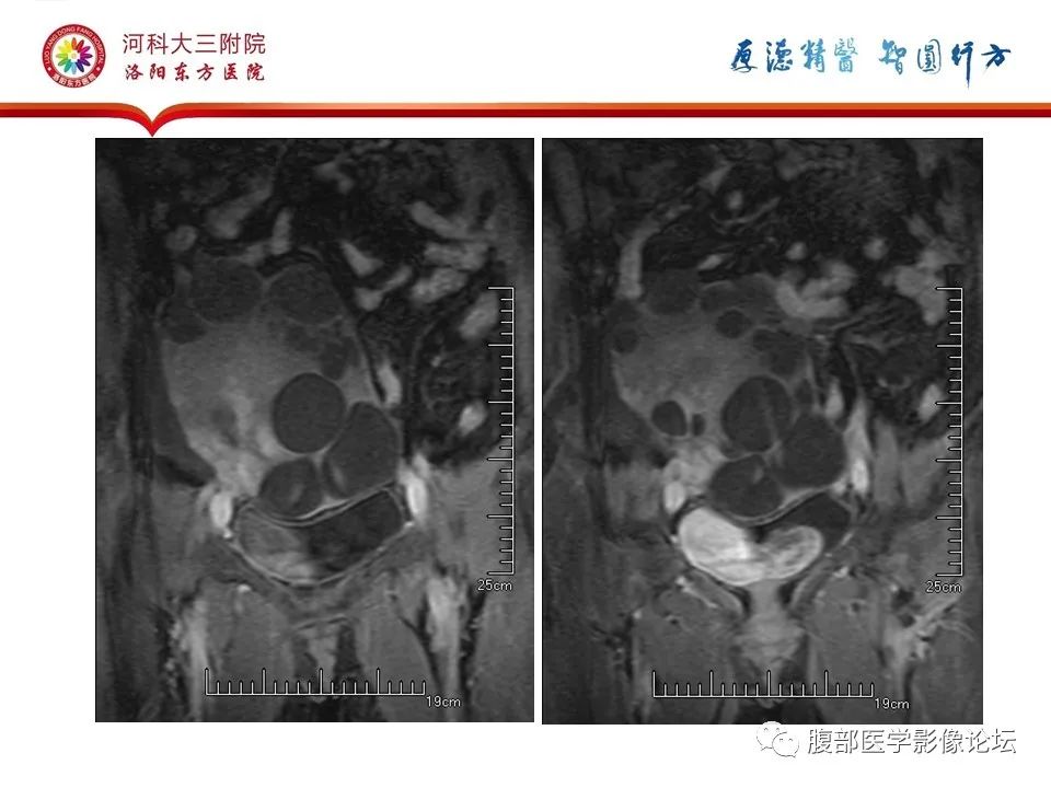 影像PPT - 【病例】卵泡膜细胞瘤1例MR影像-19