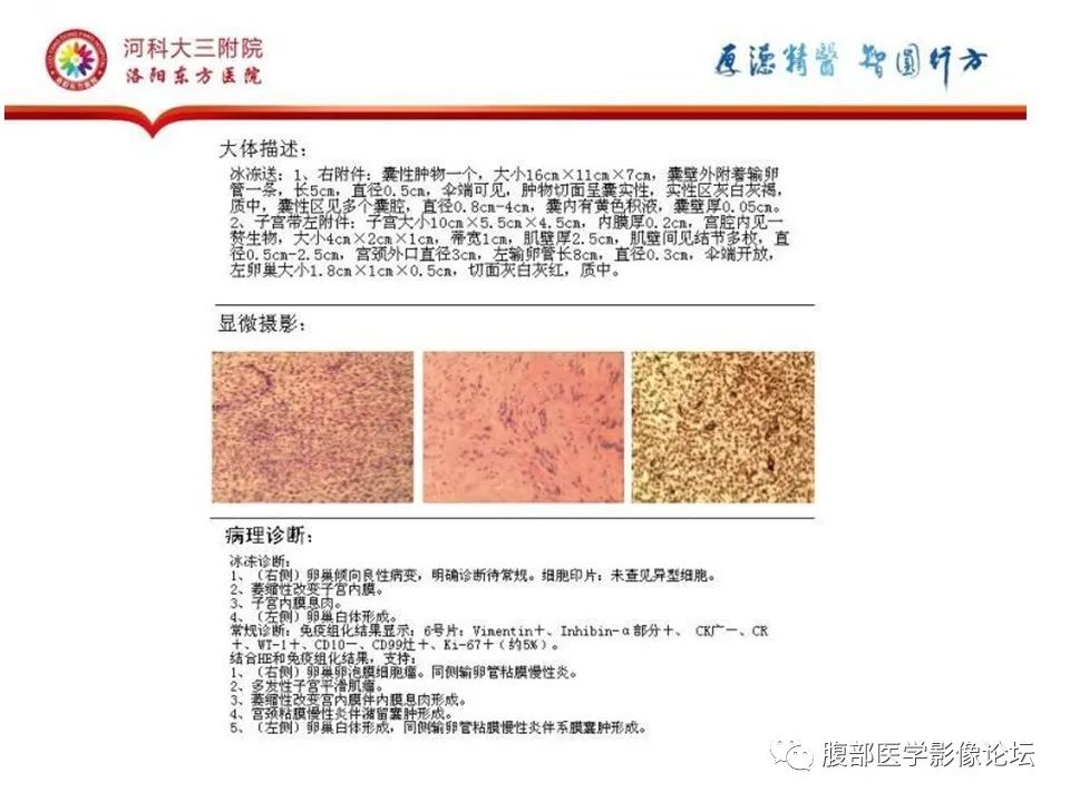 影像PPT - 【病例】卵泡膜细胞瘤1例MR影像-20