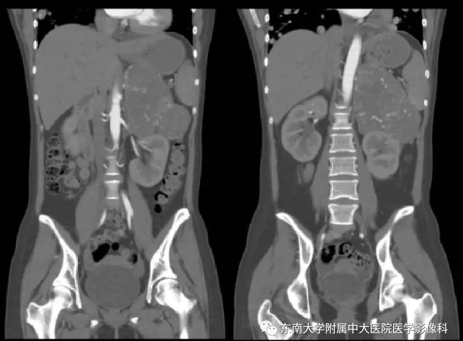 影像PPT - 【病例】肾上腺皮质癌1例CT及MR影像诊断-4