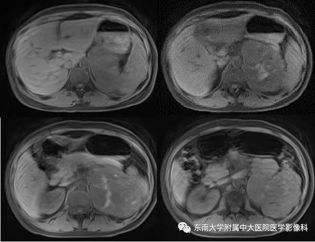 影像PPT - 【病例】肾上腺皮质癌1例CT及MR影像诊断-5