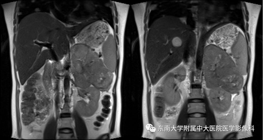 影像PPT - 【病例】肾上腺皮质癌1例CT及MR影像诊断-6