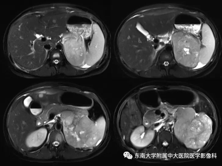 影像PPT - 【病例】肾上腺皮质癌1例CT及MR影像诊断-7