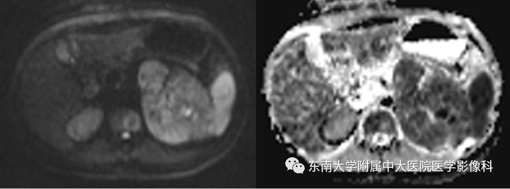 影像PPT - 【病例】肾上腺皮质癌1例CT及MR影像诊断-8