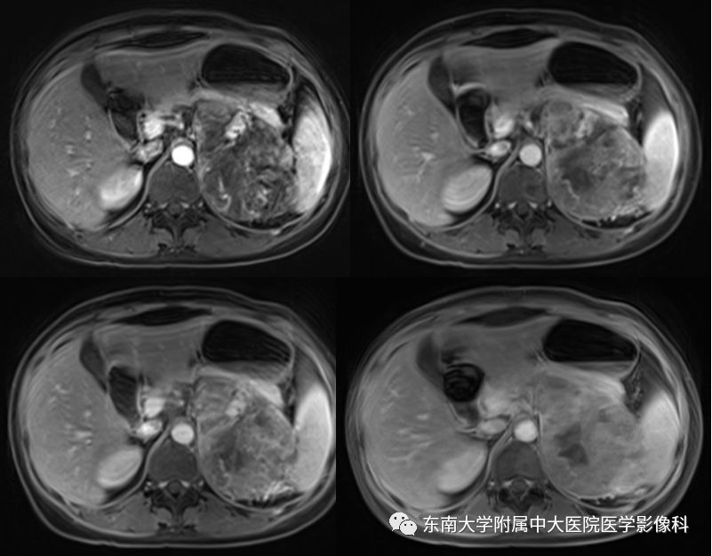影像PPT - 【病例】肾上腺皮质癌1例CT及MR影像诊断-9
