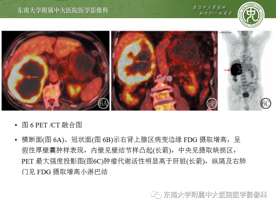 影像PPT - 【病例】肾上腺皮质癌1例CT及MR影像诊断-20