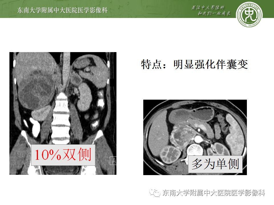 影像PPT - 【病例】肾上腺皮质癌1例CT及MR影像诊断-23