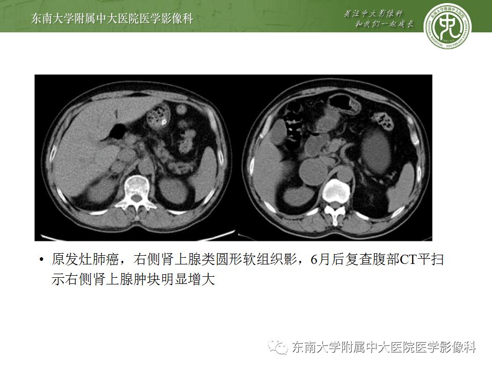 影像PPT - 【病例】肾上腺皮质癌1例CT及MR影像诊断-25
