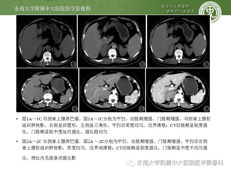 影像PPT - 【病例】肾上腺皮质癌1例CT及MR影像诊断-27