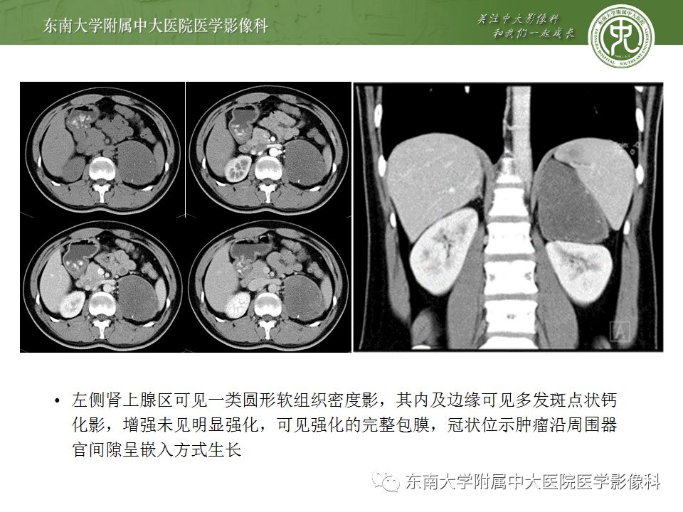 影像PPT - 【病例】肾上腺皮质癌1例CT及MR影像诊断-29