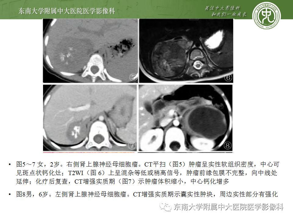 影像PPT - 【病例】肾上腺皮质癌1例CT及MR影像诊断-31