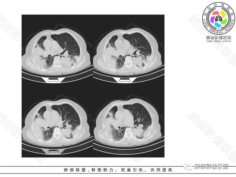 影像PPT - 【病例】隐球菌肺炎1例CT诊断要点-4
