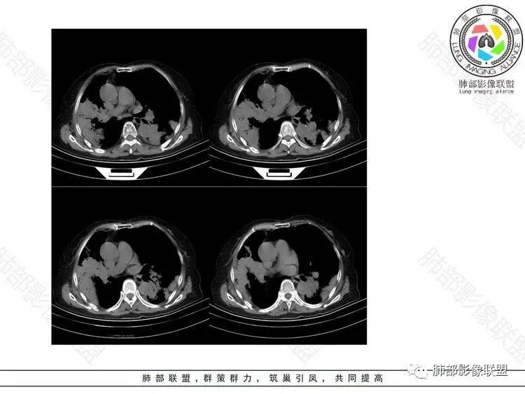 影像PPT - 【病例】隐球菌肺炎1例CT诊断要点-7