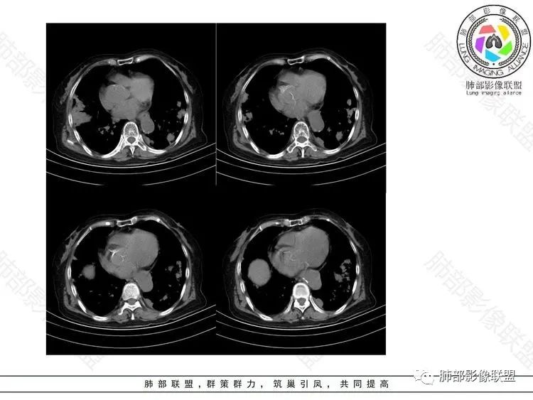 影像PPT - 【病例】隐球菌肺炎1例CT诊断要点-8
