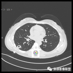 影像PPT - 【病例】隐球菌肺炎1例CT诊断要点-16