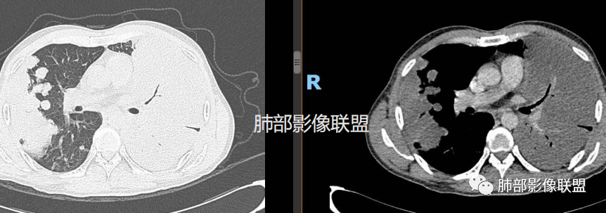 影像PPT - 【病例】隐球菌肺炎1例CT诊断要点-18