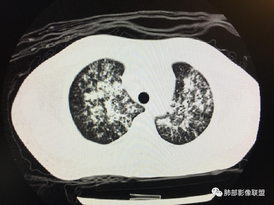 影像PPT - 【病例】隐球菌肺炎1例CT诊断要点-21