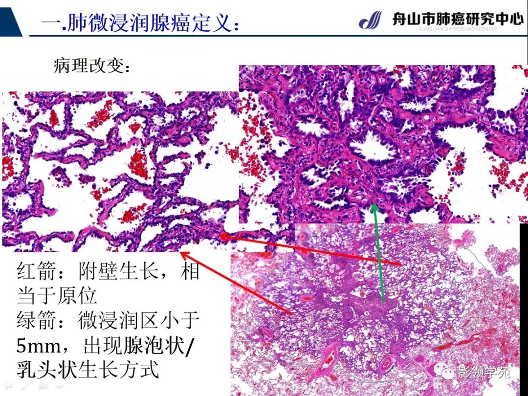 影像PPT - 【PPT】早期肺腺癌CT表现与处理策略探讨—微浸润肺腺癌-3 影像PPT - 【PPT】早期肺腺癌CT表现与处理策略探讨—微浸润肺腺癌-3