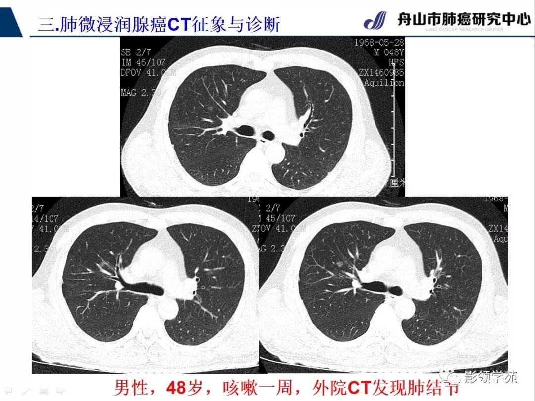 影像PPT - 【PPT】早期肺腺癌CT表现与处理策略探讨—微浸润肺腺癌-7 影像PPT - 【PPT】早期肺腺癌CT表现与处理策略探讨—微浸润肺腺癌-7