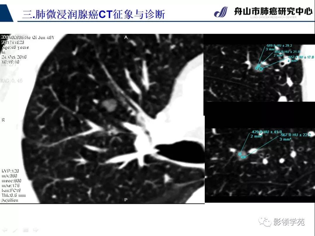 影像PPT - 【PPT】早期肺腺癌CT表现与处理策略探讨—微浸润肺腺癌-9 影像PPT - 【PPT】早期肺腺癌CT表现与处理策略探讨—微浸润肺腺癌-9