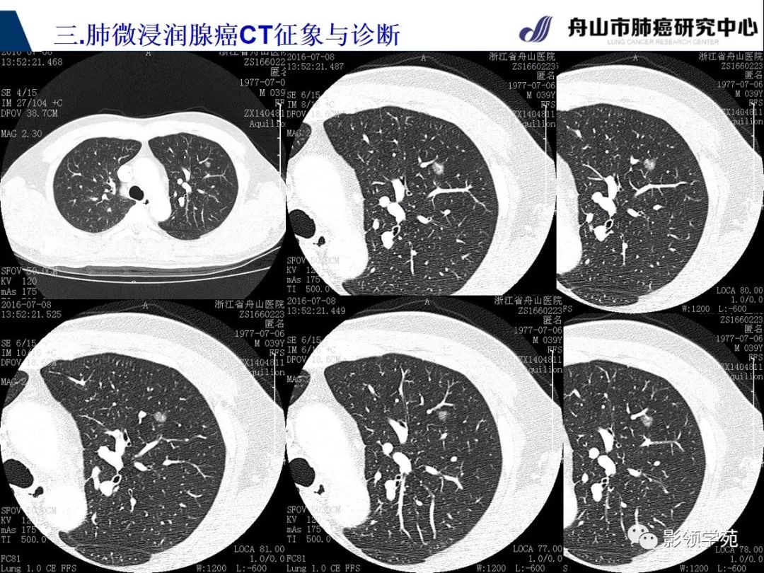 影像PPT - 【PPT】早期肺腺癌CT表现与处理策略探讨—微浸润肺腺癌-11 影像PPT - 【PPT】早期肺腺癌CT表现与处理策略探讨—微浸润肺腺癌-11