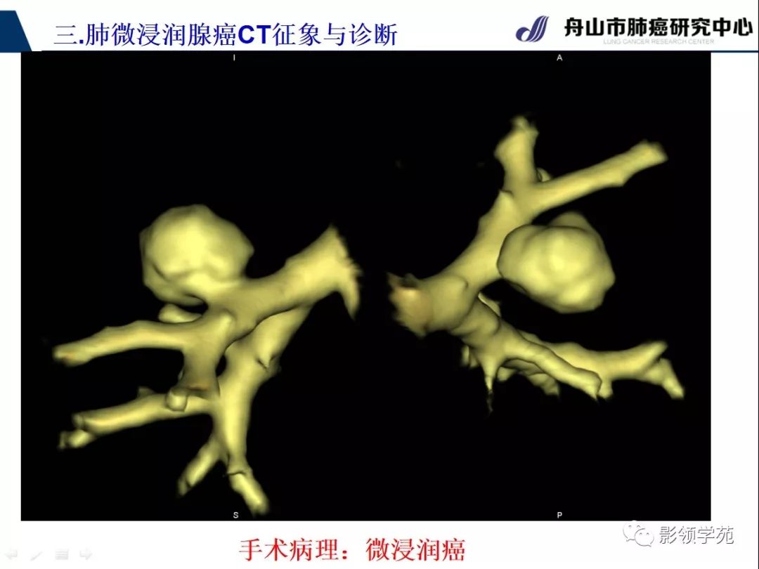 影像PPT - 【PPT】早期肺腺癌CT表现与处理策略探讨—微浸润肺腺癌-12 影像PPT - 【PPT】早期肺腺癌CT表现与处理策略探讨—微浸润肺腺癌-12