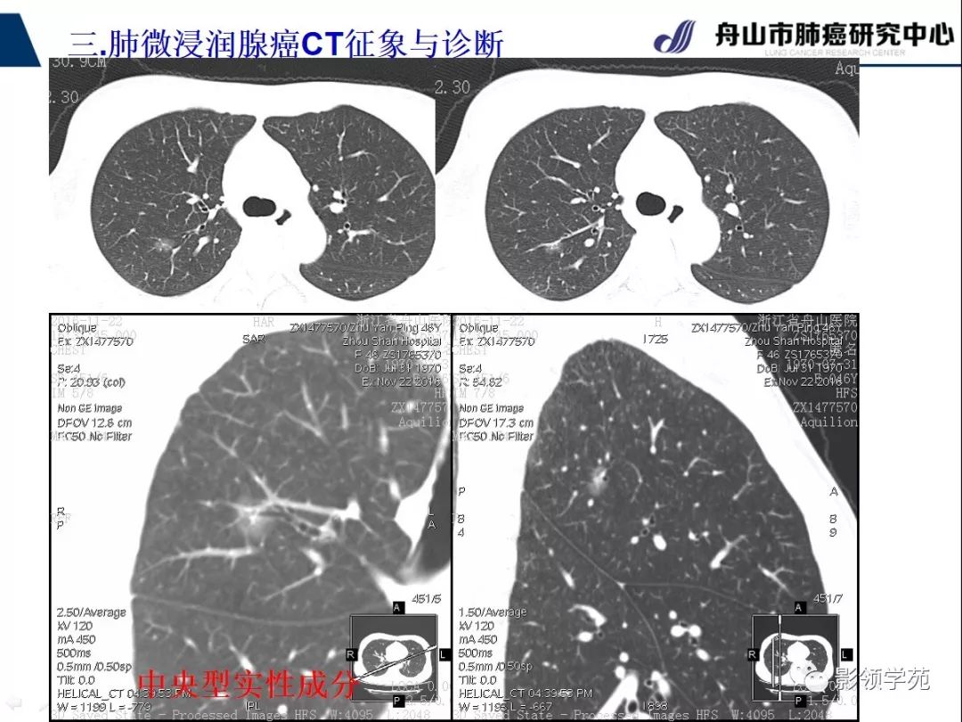 影像PPT - 【PPT】早期肺腺癌CT表现与处理策略探讨—微浸润肺腺癌-13 影像PPT - 【PPT】早期肺腺癌CT表现与处理策略探讨—微浸润肺腺癌-13
