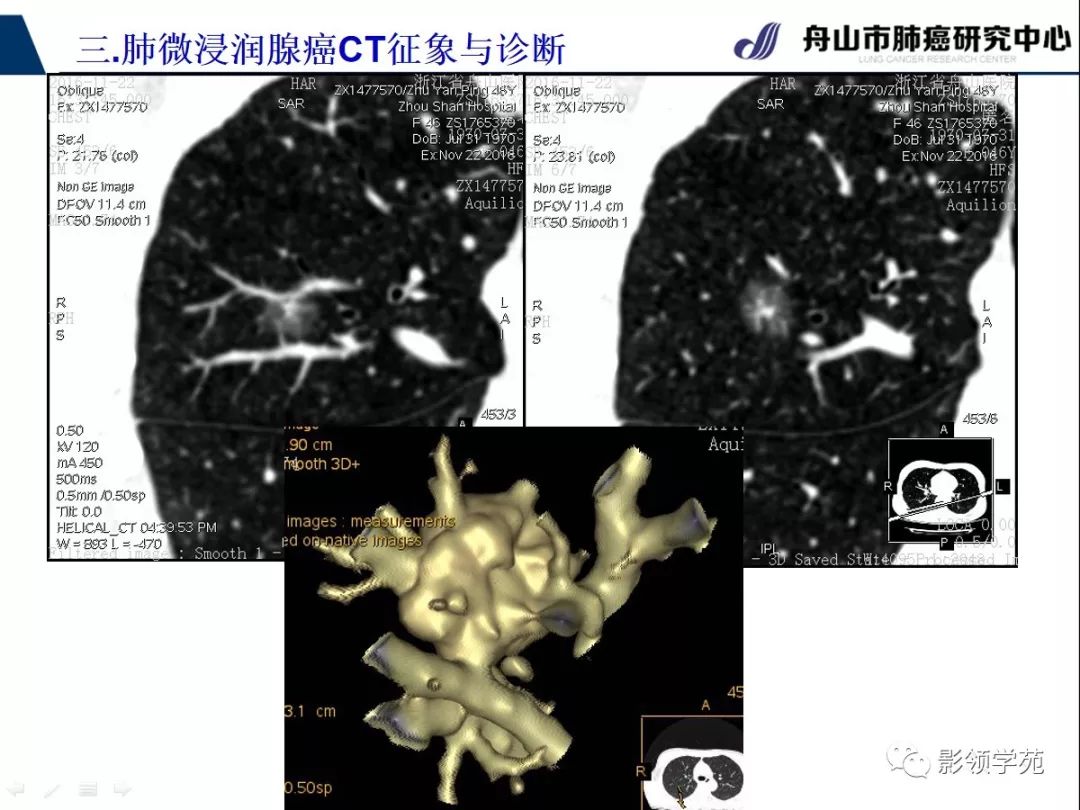 影像PPT - 【PPT】早期肺腺癌CT表现与处理策略探讨—微浸润肺腺癌-14 影像PPT - 【PPT】早期肺腺癌CT表现与处理策略探讨—微浸润肺腺癌-14