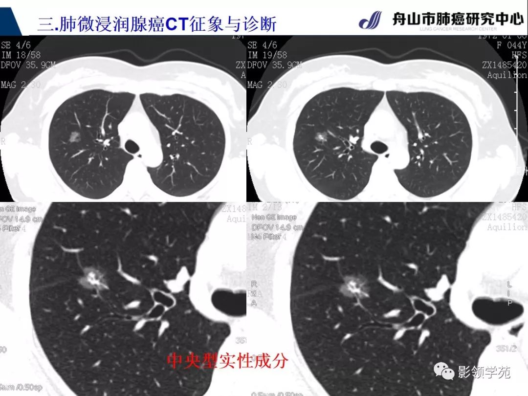 影像PPT - 【PPT】早期肺腺癌CT表现与处理策略探讨—微浸润肺腺癌-15 影像PPT - 【PPT】早期肺腺癌CT表现与处理策略探讨—微浸润肺腺癌-15