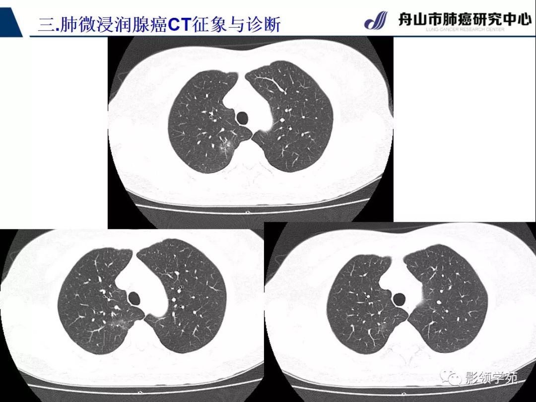 影像PPT - 【PPT】早期肺腺癌CT表现与处理策略探讨—微浸润肺腺癌-18 影像PPT - 【PPT】早期肺腺癌CT表现与处理策略探讨—微浸润肺腺癌-18
