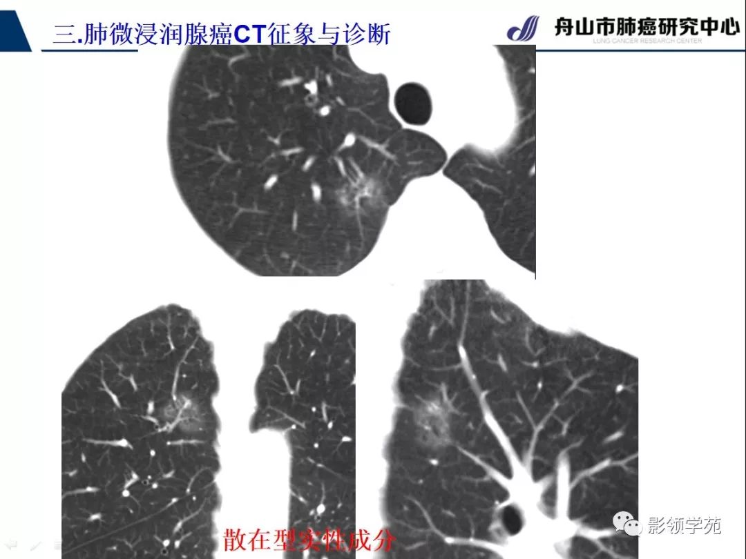 影像PPT - 【PPT】早期肺腺癌CT表现与处理策略探讨—微浸润肺腺癌-19 影像PPT - 【PPT】早期肺腺癌CT表现与处理策略探讨—微浸润肺腺癌-19