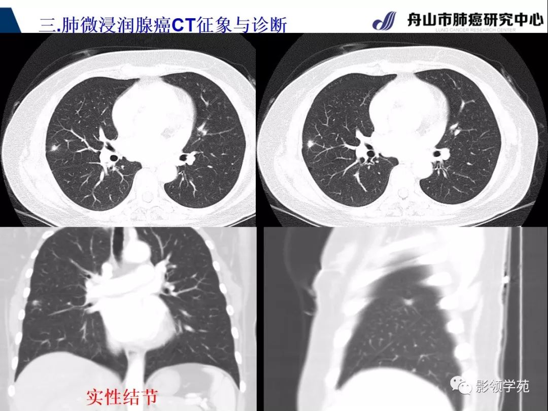 影像PPT - 【PPT】早期肺腺癌CT表现与处理策略探讨—微浸润肺腺癌-22 影像PPT - 【PPT】早期肺腺癌CT表现与处理策略探讨—微浸润肺腺癌-22