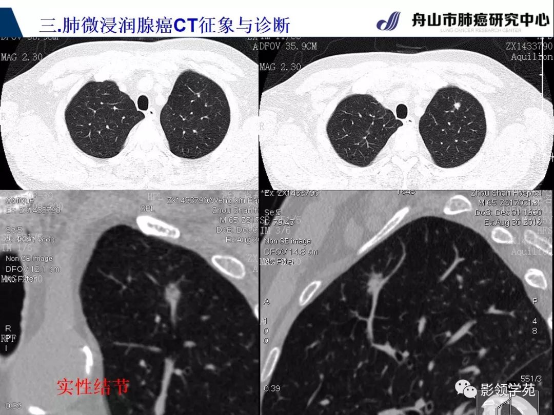 影像PPT - 【PPT】早期肺腺癌CT表现与处理策略探讨—微浸润肺腺癌-23 影像PPT - 【PPT】早期肺腺癌CT表现与处理策略探讨—微浸润肺腺癌-23