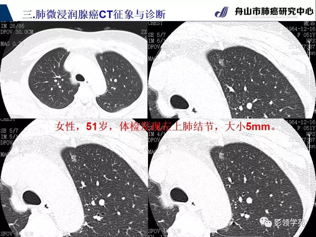 影像PPT - 【PPT】早期肺腺癌CT表现与处理策略探讨—微浸润肺腺癌-25 影像PPT - 【PPT】早期肺腺癌CT表现与处理策略探讨—微浸润肺腺癌-25