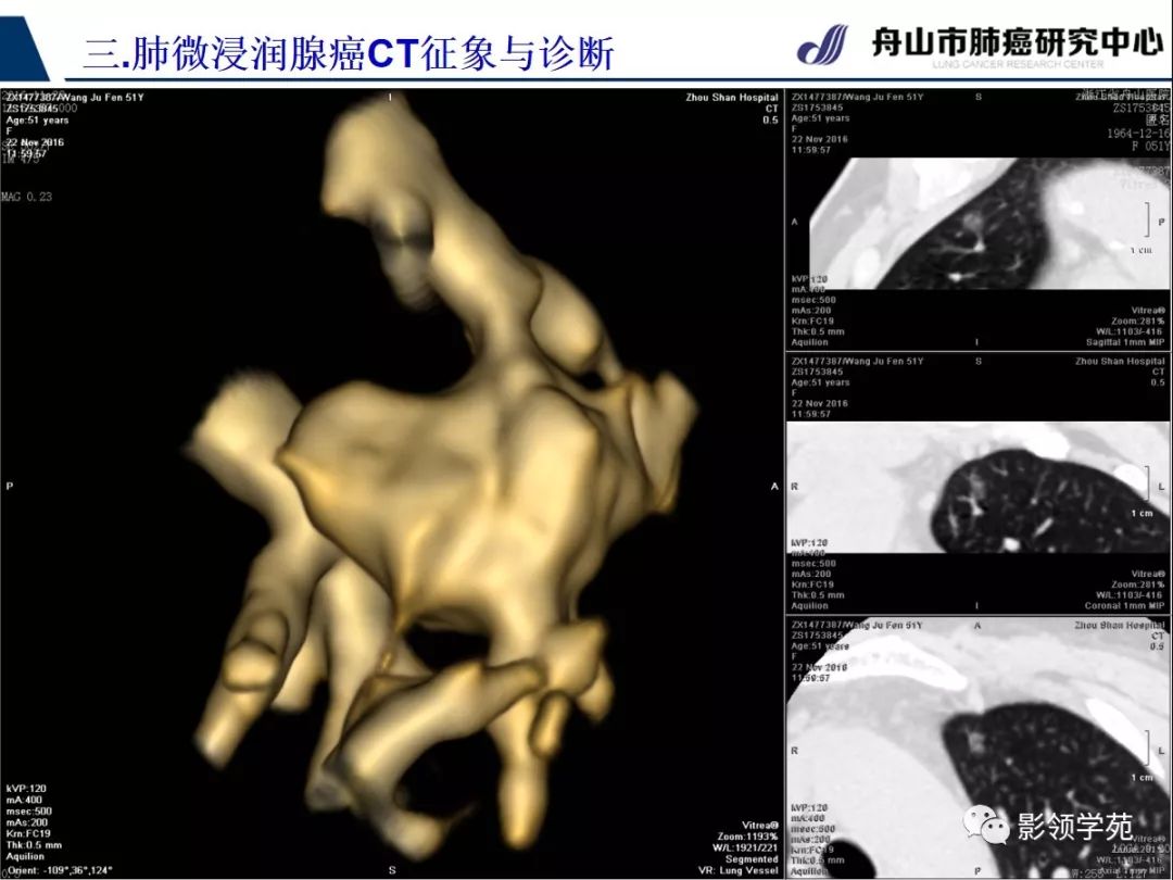 影像PPT - 【PPT】早期肺腺癌CT表现与处理策略探讨—微浸润肺腺癌-26 影像PPT - 【PPT】早期肺腺癌CT表现与处理策略探讨—微浸润肺腺癌-26